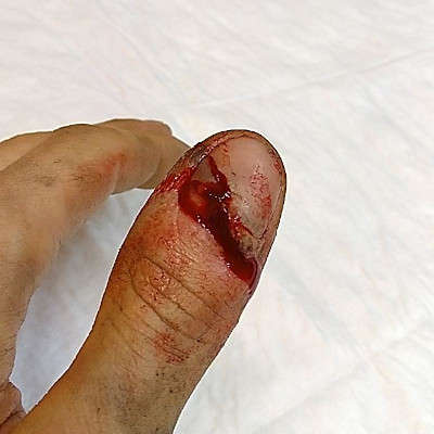 Photo du doigt, juste après l'accident